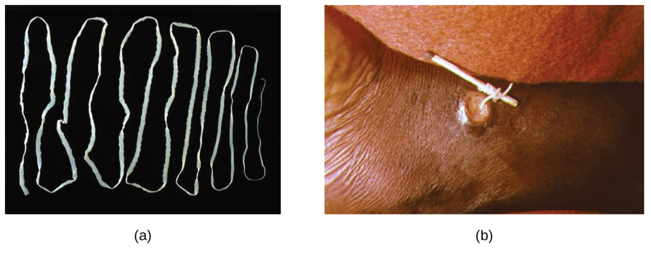 A long, flat, white worm folded back and forth on a black background, and a lesion on a patient. A worm is being pulled out of the lesion and being wrapped around a matchstick.