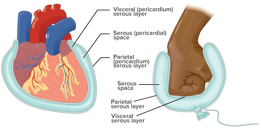 This diagram shows the pericardium on the left next to an analogy of a hand punching a balloon on the right. The pericardium is a two-layered sac that surrounds the entire heart except where the blood vessels emerge on the heart’s superior side. The pericardium has two layers because it folds over itself in the shape of the letter U. The inner layer that borders the heart is the visceral pericardium while the outer layer is the parietal pericardium. The cavity between the two layers is called the pericardial space. The heart sits in the space much like a fist punching into a balloon. The balloon surrounds the lower part of the fist with a two-layered sac, with the top of the balloon, where it contacts the fist, being analogous to the visceral pericardium. The bottom of the balloon, where it is tied off, is analogous to the parietal pericardium. The air within the balloon is analogous to the pericardial space.