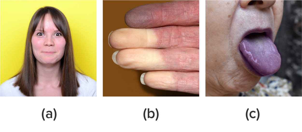 (a) image of a face red or blushed with extra oxygenated blood (b) image of fingers. The tips are white due to poor blood circulation while the bases of the fingers are pink. (c) image shows a stuck out tongue with a purple or blue appearance