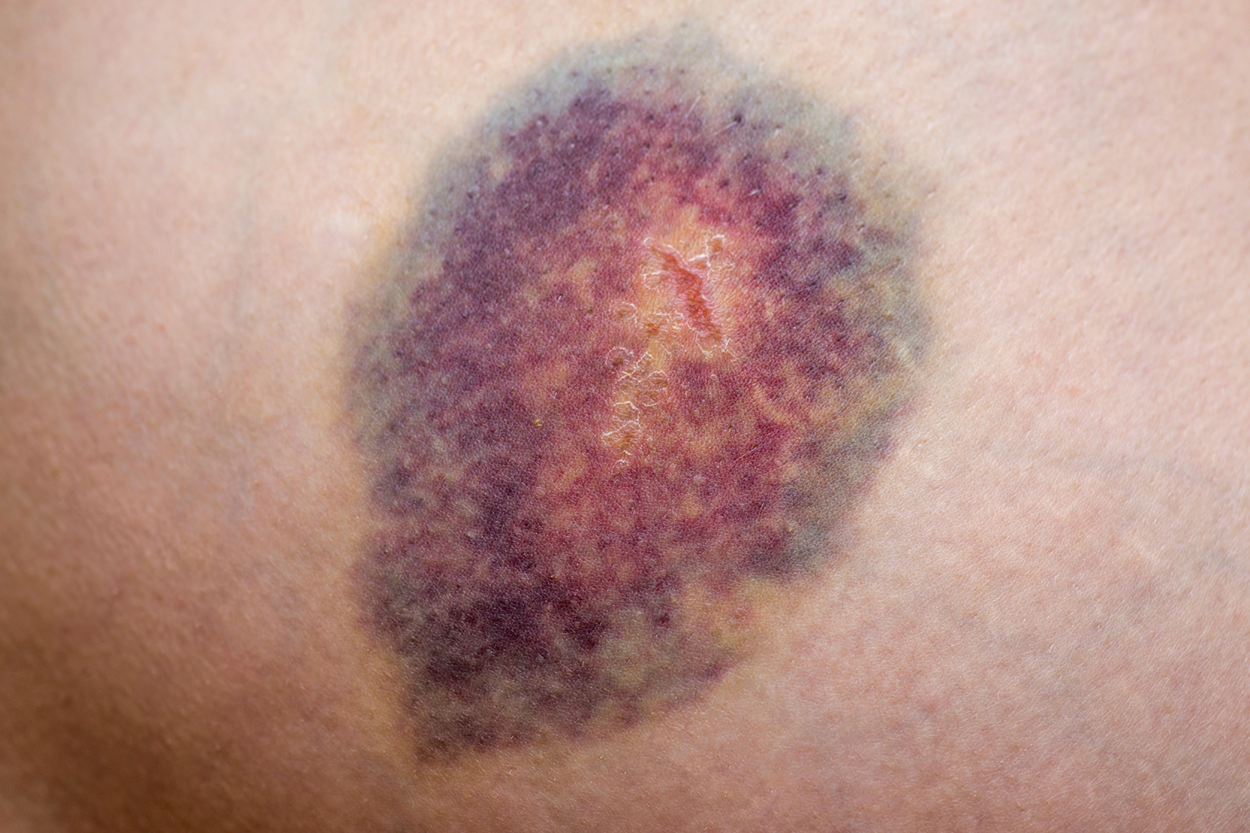 Image shows a deep skin bruise with concentric circles of colors. The outer perimeter is blue transitioning into purples and reds and includes greens, yellows, and browns.