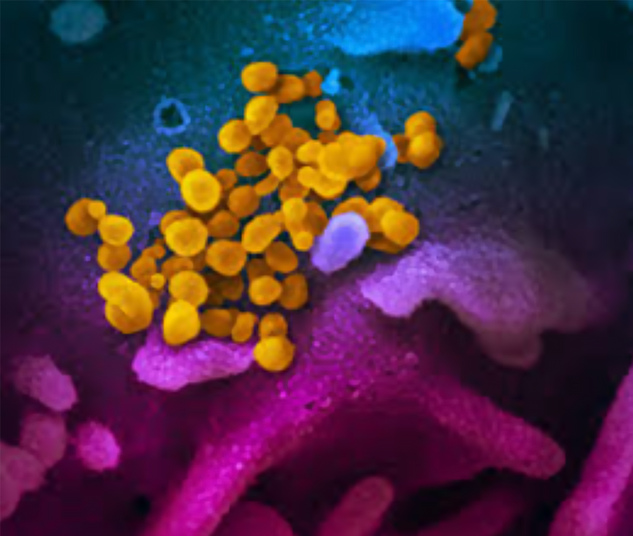 COVID virus (in yellow) viewed with Scanning Electron Microscope.