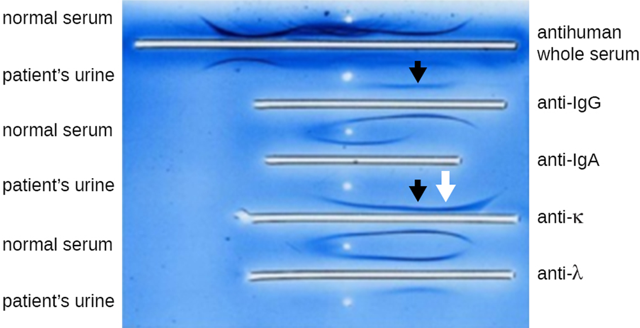 A photograph showing various white lines on a blue background. The sources of the samples producing the lines are listed on the left from top to bottom as three sets of normal serum and patient urine. Each of these labels is associated with a horizontal line that has varying precipitin arcs above and below. The lines are labeled with antisera from top to bottom as follows: anti-human whole serum, anti-IgG, anti-IgA, anti-kappa, and anti-lambda. There are arrows indicating skewed arcs above the second and fourth lines. Black arrows point to the patient’s sample next to anti-IgG and anti-kappa. A white arrow points to the band from the patient near anti-kappa.