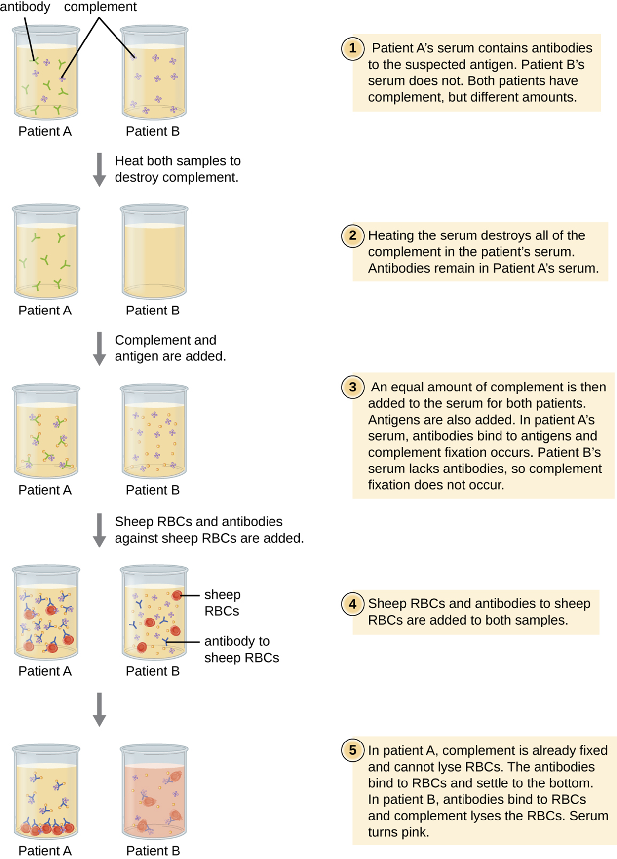 Diagram of the complement fixation test. 1. Patient A’s serum contains antibodies to the suspected antigen. Patient B’s serum does not. Both patients have complement, but different amounts. 2. Heating the serum destroys all of the complement in the patient’s serum. Antibodies remain in patient A’s serum. 3. An equal amount of complement is then added to the serum for both patients. Antigens are also added. In patient A’s serum, antibodies bind to antigens and complement fixation occurs. Patient B’s serum lacks antibodies, so complement fixation does not occur. 4. Sheep RBCs and antibodies to sheep RBCs are added to both samples. 5. In patient A, the complement is already fixed and cannot lyse RBCs. The antibodies bind to RBCs and settle to the bottom. In patient B, antibodies bind to RBCs and complement lyses the RBCs. The serum turns pink.