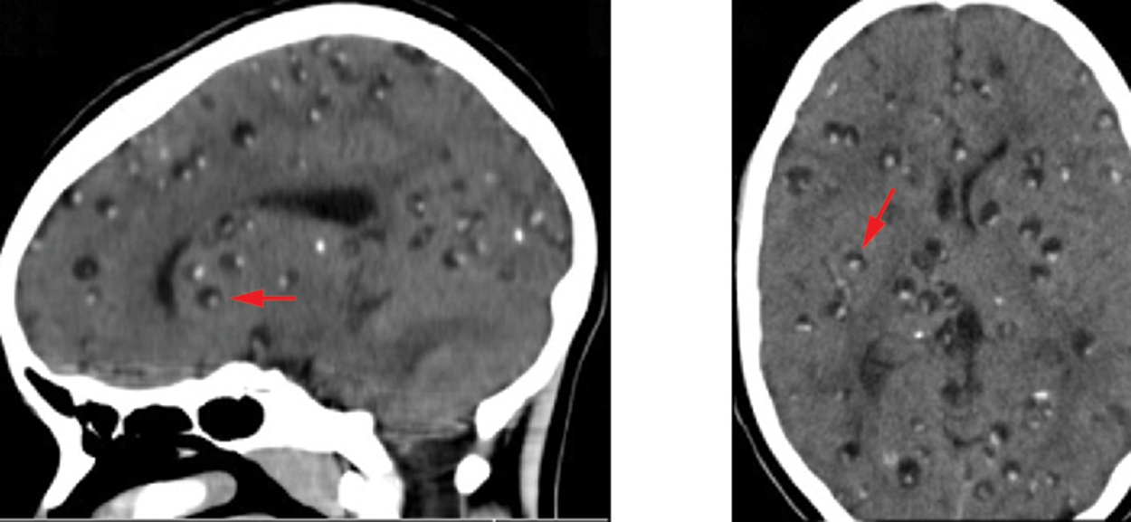 Brain scans with small lumps (look like pimples) indicated by arrows.