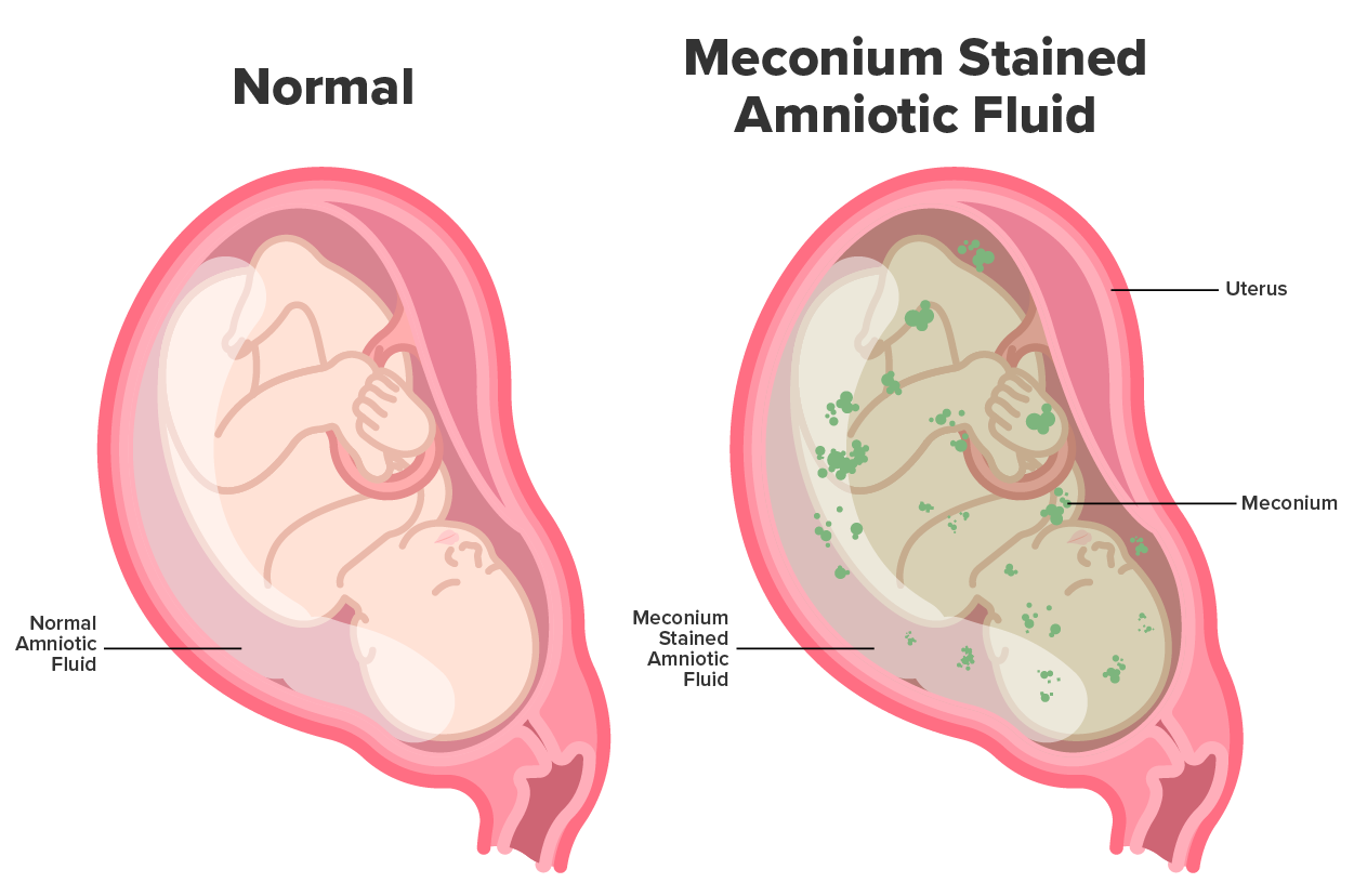 Illustation depicting meconium aspiration syndrome.  The left shows normal amniotic fluid around a fetus.  The fluid is clear.  The right shows meconium-stained amniotic fluid (shown as darker fluid).  There are also spots of meconium shown as green spots in the fluid.