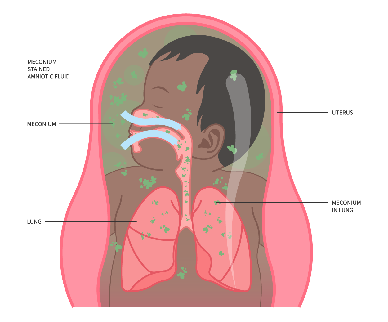 Illustration shows a fetus in the uterus that is in meconium-stained amniotic fluid containing meconium particles.  Once the fetus breathes in amniotic fluid, we see meconium in the lungs of the fetus.