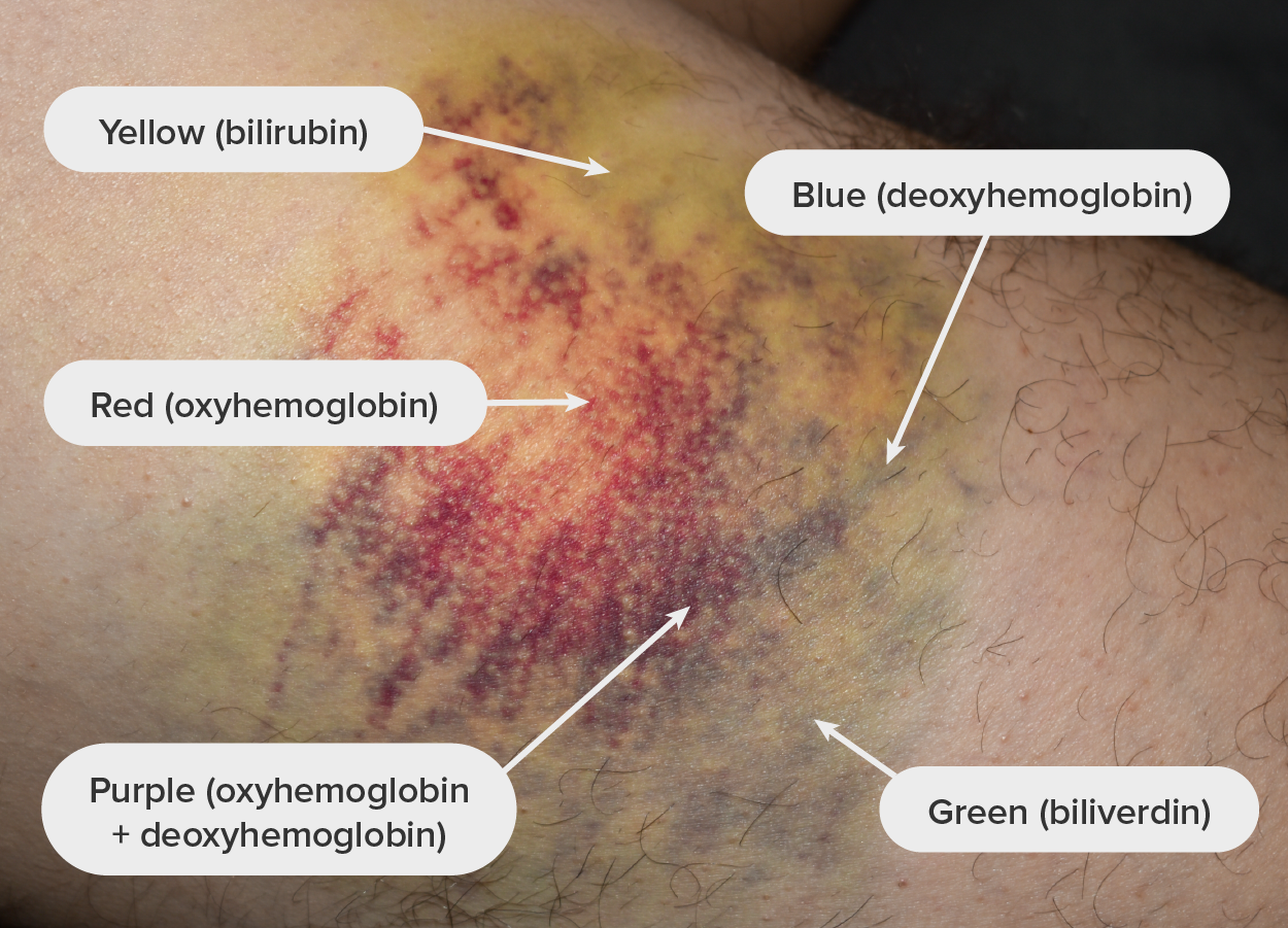 Bruise—Over time, a bruise will display multiple different colors based on the oxygen status of hemoglobin and production of its breakdown products.